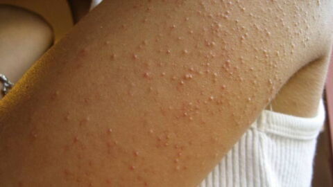 Glutenunverträglichkeit und ihre Symptome