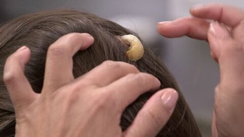 Frau hat ein Jahr lang eine Beule am Kopf: Dann geht sie zum Arzt
