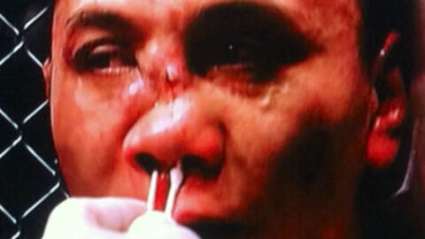 Das tut richtig weh: Die übelsten MMA-Verletzungen aller Zeiten!