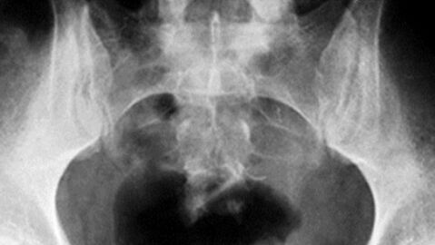 24 Gegenstände, die im Rektum von Patienten gefunden wurden