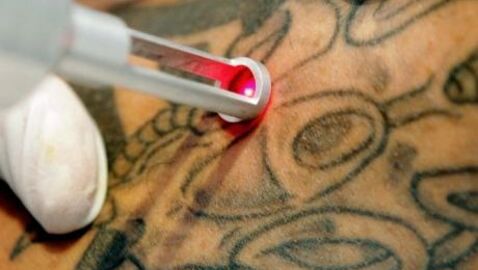 Tattoo-Entfernung per Laser
