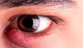 Gerstenkorn am Auge (Hordeolum): Was tun? Behandlung, Dauer, Salbe, Therapie und Symptome