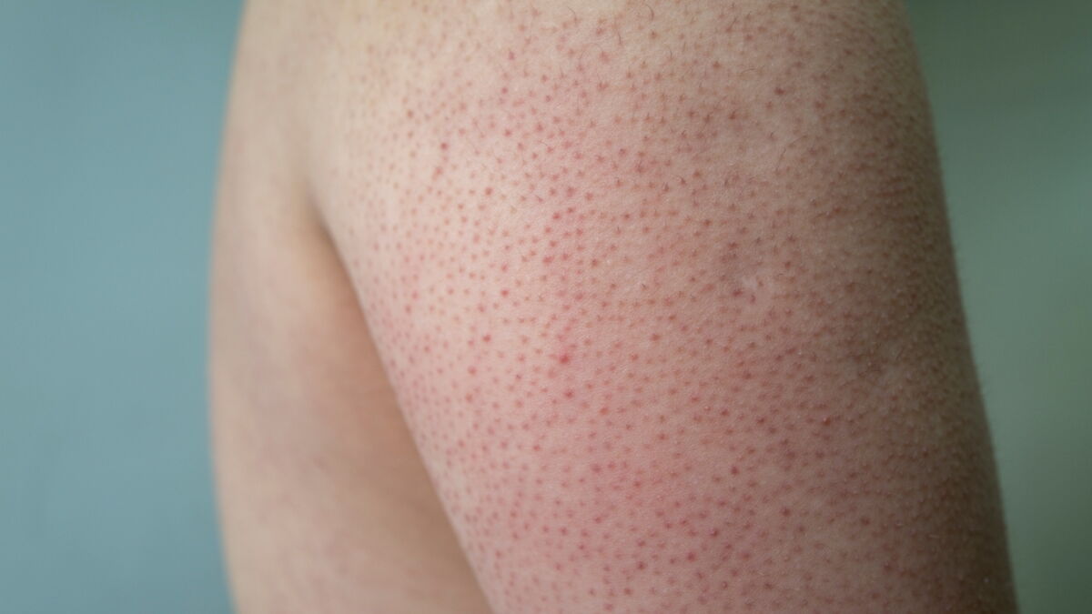 Reibeisenhaut (Keratosis pilaris): Mit diesem Tipp lässt sich das ...