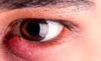 Gerstenkorn am Auge (Hordeolum): Was tun? Behandlung, Dauer, Salbe, Therapie und Symptome