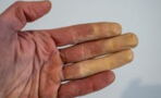 Raynaud-Syndrom: Das kann man gegen Leichenfinger tun
