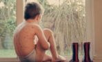 Windpocken: Kinderärztin gibt wichtige Tipps zur Bekämpfung der Symptome