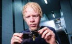 Vom Mobbingopfer zum Werbestar: Albino-Model startet durch