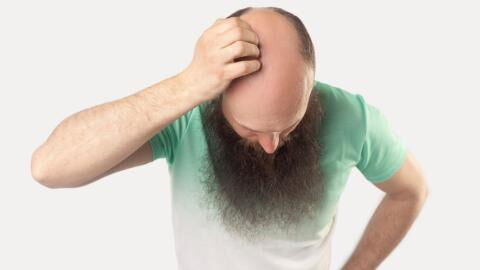 Vollbart trotz Glatze: Dieser Grund steckt dahinter