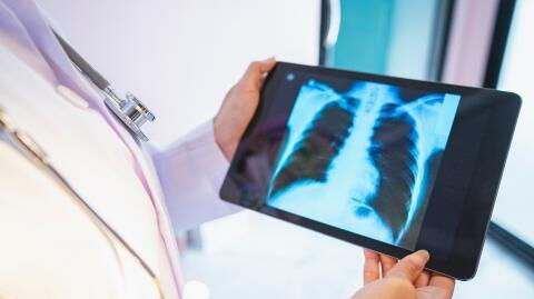 Durchbruch in der Lungenkrebsforschung: Können alte Viren den Krebs heilen?