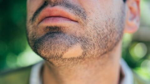 Kein normaler Bartwuchs? Dann hat dein Körper diesen Mangel