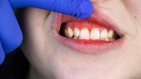 Krankheit aus dem 18. Jahrhundert breitet sich in Industrieländern wieder aus