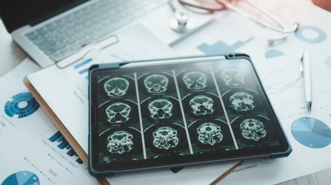 Alzheimer Sorge? Die Überraschende Verbindung: Ist Lithiummangel Der Zündfunke Für Alzheimer? - 7huqj3m