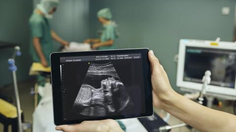 "Steinbaby": Brasilianerin ist über 50 Jahre "schwanger" und stirbt nach Entfernung des Fötus