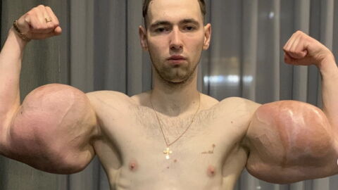 Aufgespritzte Muskeln: Kurze Zeit später stirbt das Gewebe des Russen ab