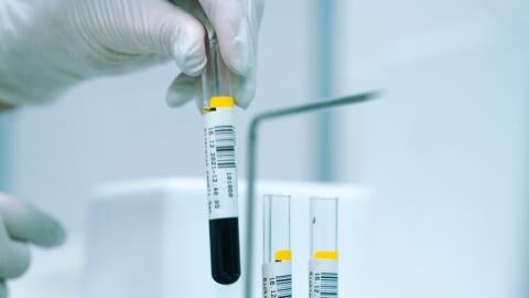 Neue Behandlungsmethode: Kann Nabelschnurblut HIV-Patienten heilen?