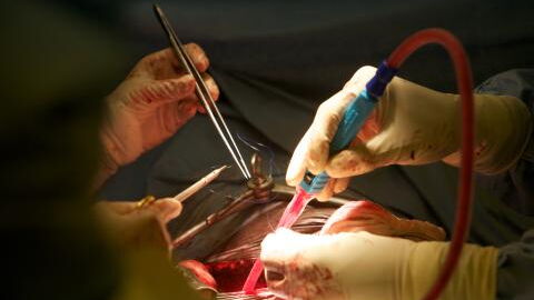 Lebensgefährlicher Ärzte-Pfusch: Organverwechslung im OP kostet Rentner das Leben