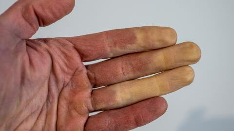 Raynaud-Syndrom: Das kann man gegen Leichenfinger tun