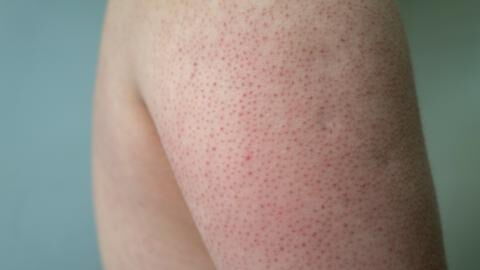 Reibeisenhaut (Keratosis pilaris): Mit diesem Tipp lässt sich das Hautbild verbessern