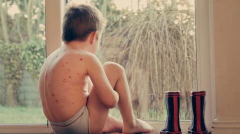 Windpocken: Kinderärztin gibt wichtige Tipps zur Bekämpfung der Symptome