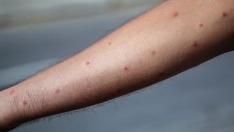 Mücken-Opfer: Darum wirst du häufiger als andere von Mücken gestochen