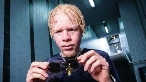 Vom Mobbingopfer zum Werbestar: Albino-Model startet durch