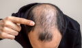 Gegen Haarausfall: Start-Up hat einen genialen Durchbruch