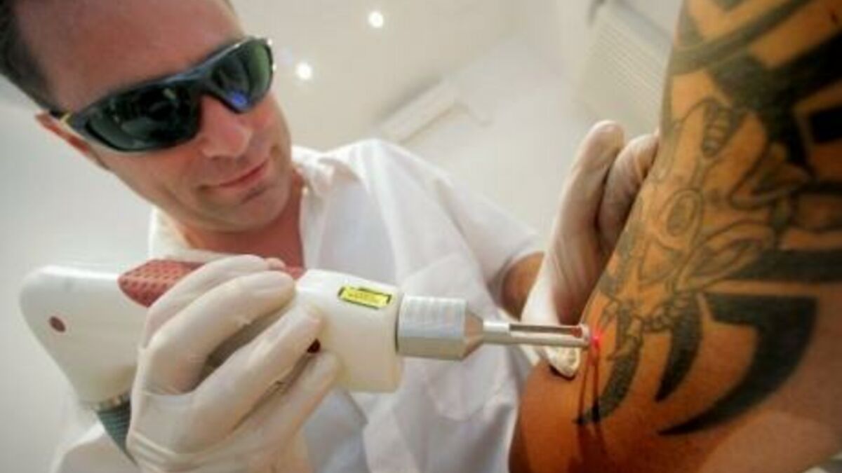 En images effacer un tatouage au laser, oui mais comment