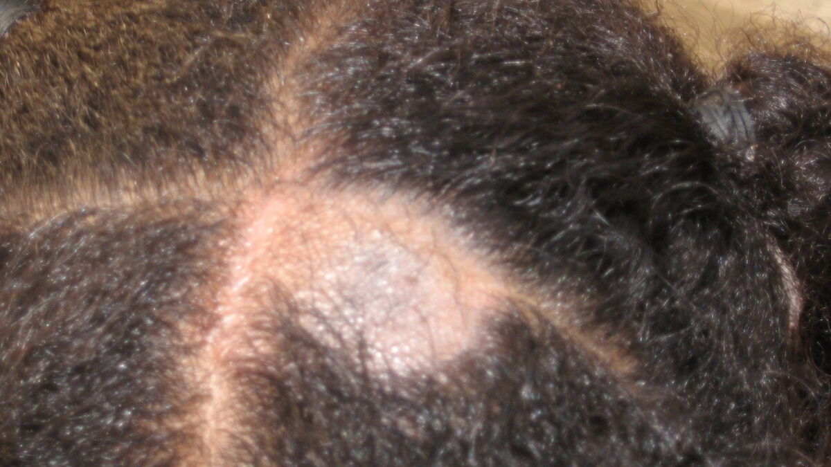 Teigne Chat Chien Humain Symptomes Tout Savoir Sur Cette Infection