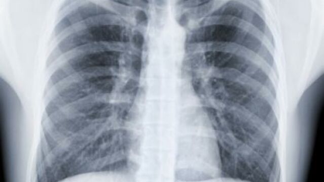 Les différentes classes sociales, inégales face au cancer du poumon