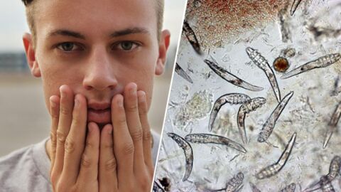 Les Demodex, ces millions d'acariens qui vivent sur votre visage