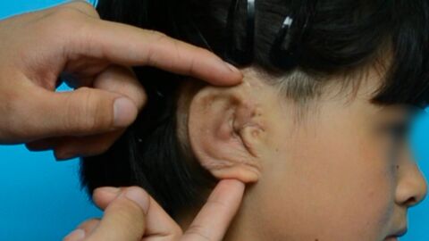 Des médecins reconstruisent les oreilles de cinq enfants à partir de leurs propres cellules