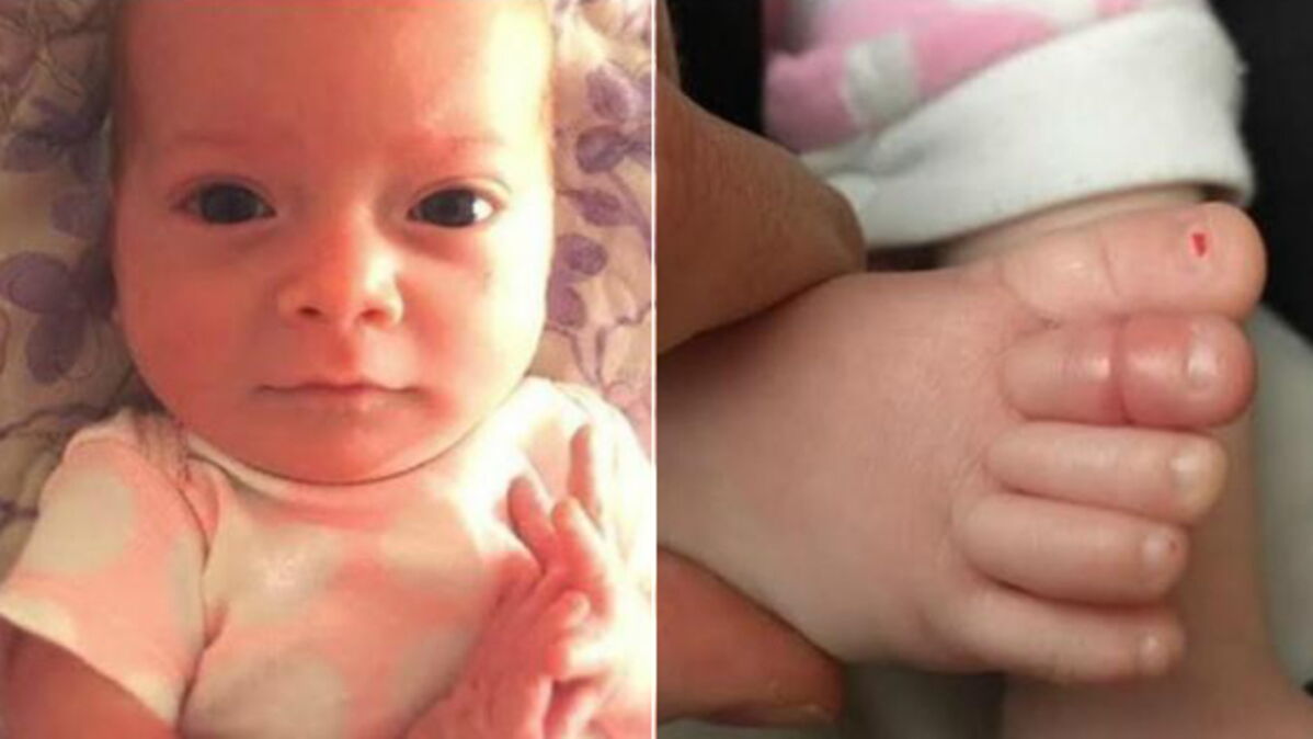 Le syndrome du tourniquet comment un simple cheveu peut être