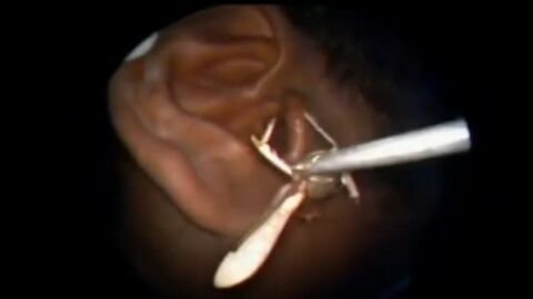 Un homme se fait retirer un criquet vivant de l’oreille