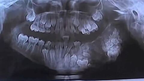 Un jeune Indien se fait retirer 80 dents en une seule opération