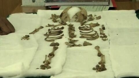 Le squelette d'un foetus mort enlevé 36 ans après du ventre de sa mère