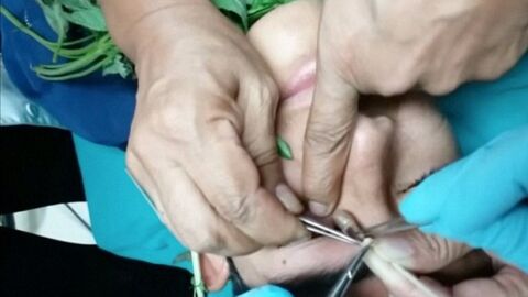 Des médecins retirent une larve logée dans l’œil d'un patient grâce à une technique étonnante