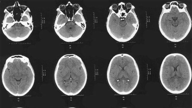 Scanner cérébral avec ou sans injection : définition, déroulement et risques