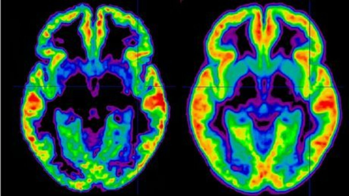 Schizophrénie définition, symptômes, traitement, causes, qu'est ce