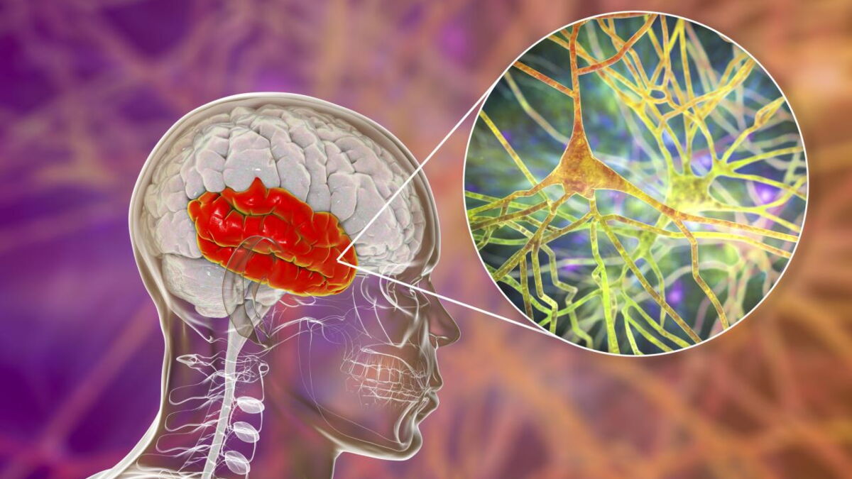 Syndrome de Korsakoff définition, symptômes, traitement, de quoi s