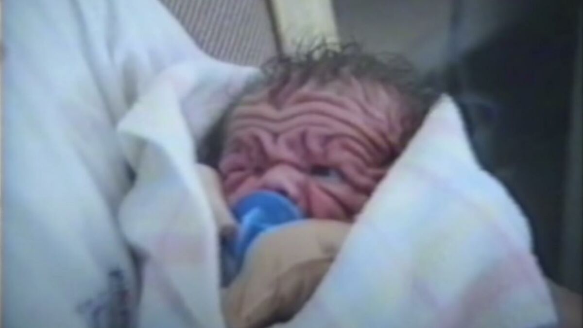 Un bébé d'un an dans un état grave après avoir été ébouillanté
