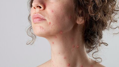 Pourquoi la varicelle est plus dangereuse chez l'adulte que chez l'enfant ?