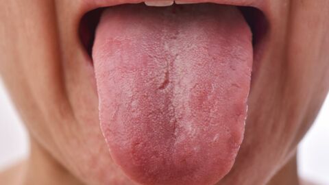 Covid-19 : la "langue Covid", nouveau symptôme du virus ?