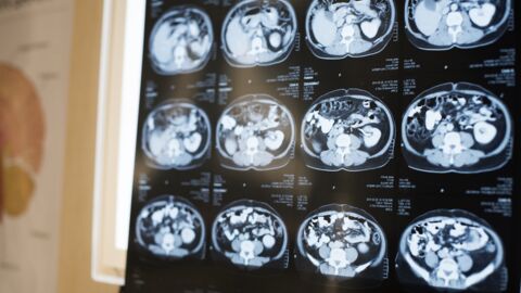 États-Unis : victime de violentes migraines, il découvre qu'un ver solitaire vit dans son cerveau depuis 10 ans
