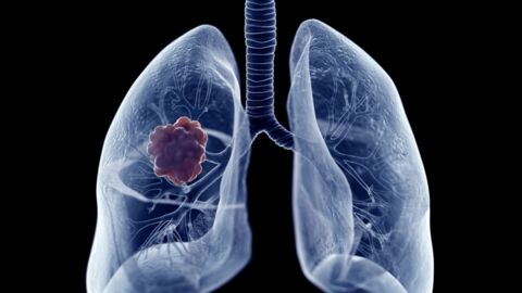 Cancer du poumon : une étude révèle 3 origines de la maladie chez les non-fumeurs