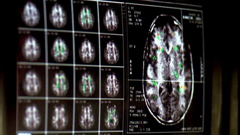 Covid-19 : une atrophie de la matière grise du cerveau observée chez les malades