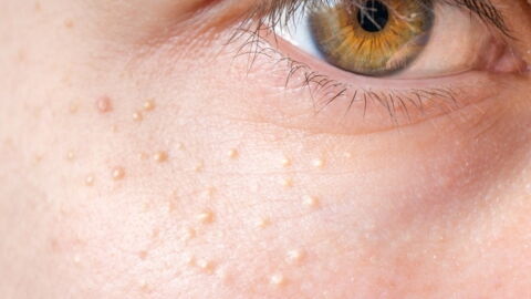 The Irritating Little White Spots On My Face Are Finally Gone