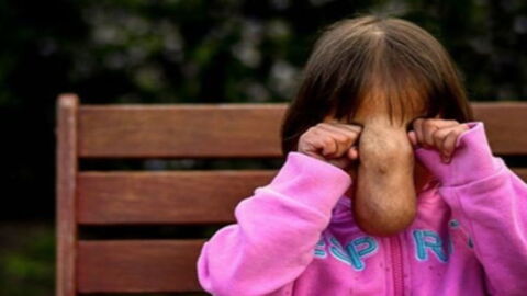 This girl had a facial hernia but a trip to Australia changed her life forever