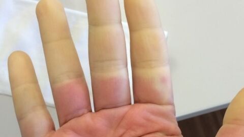 Raynaud S Disease Treatment Causes And Diagnosis