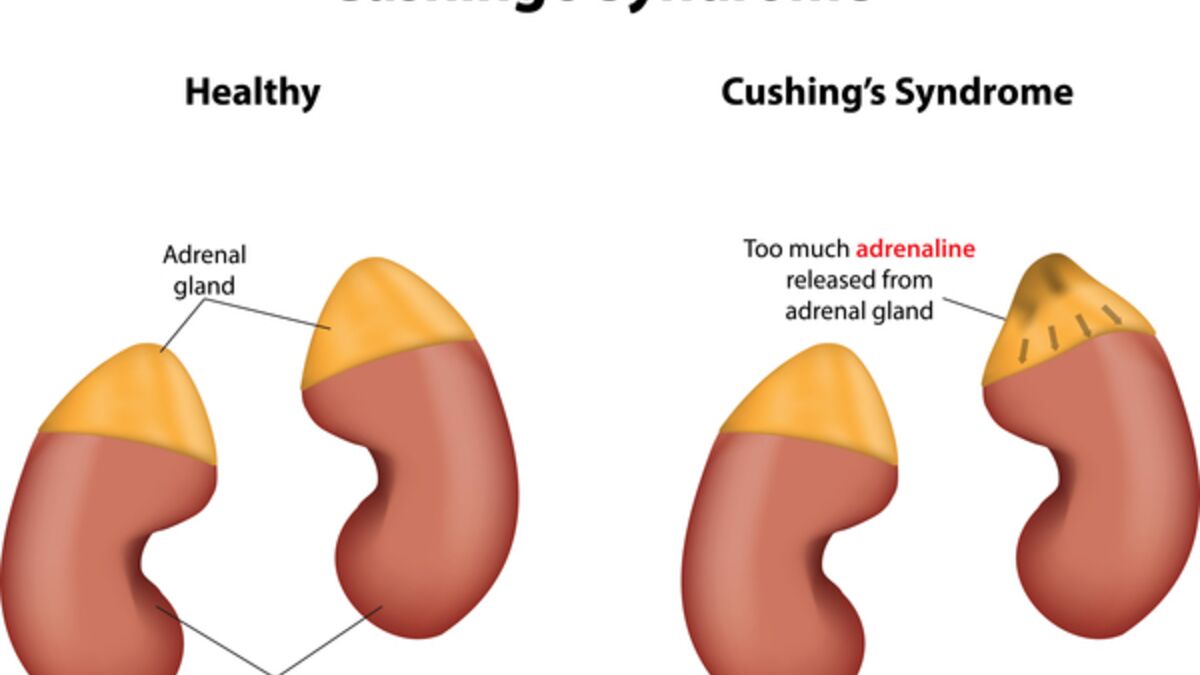 Everything You Need To Know About Cushings Syndrome 