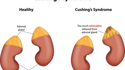 Everything You Need To Know About Cushing's Syndrome